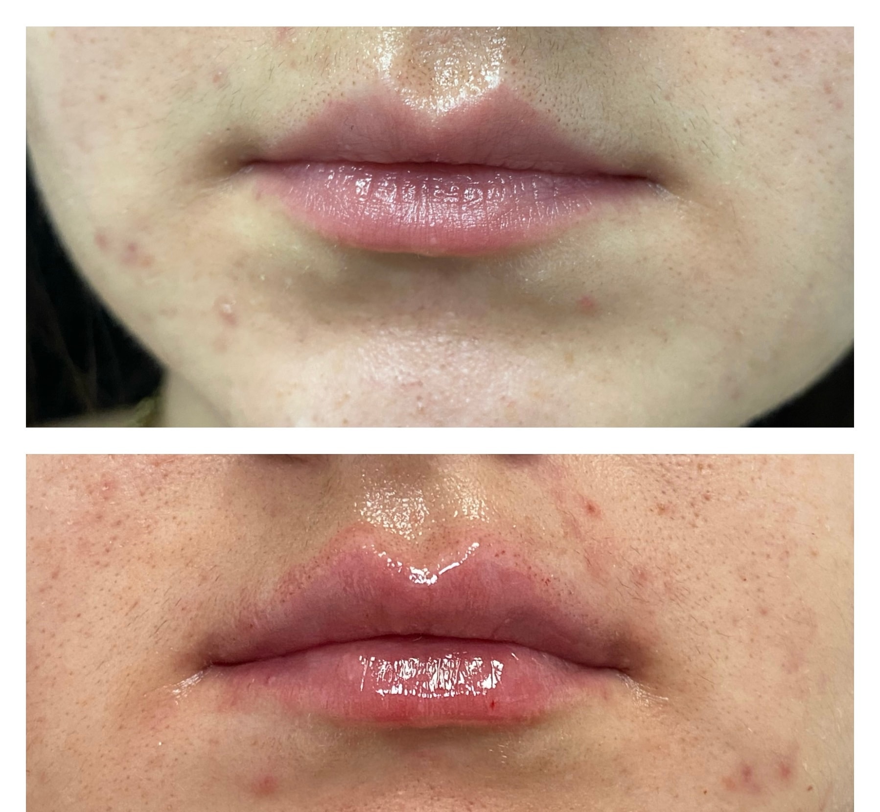 Relleno labial antes y después